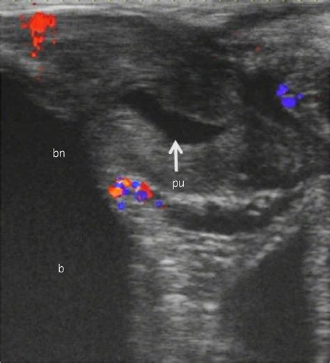 Male squirting: Analysis of one case using color Doppler ...